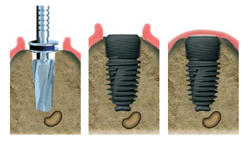 Implant dentaire Lisieux