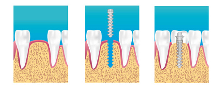 Implant dentaire Liscieux